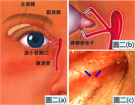 干眼癥,干眼癥癥狀,干眼癥成因,干眼癥治療