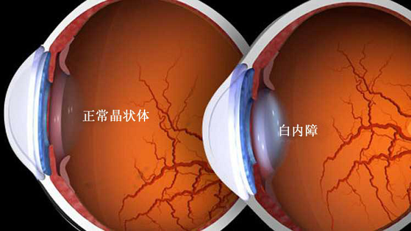 白內(nèi)障,青光眼,白內(nèi)障手術(shù),惠州希瑪眼科醫(yī)院