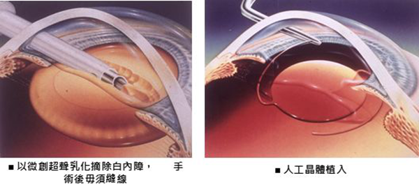 白內(nèi)障,青光眼,白內(nèi)障手術(shù),惠州希瑪眼科醫(yī)院
