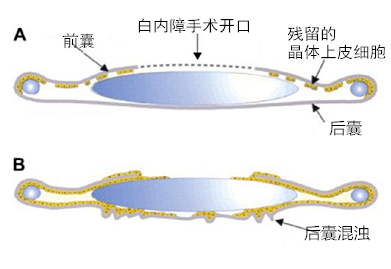 白內障,人力,出現,白內障手術,手術治療