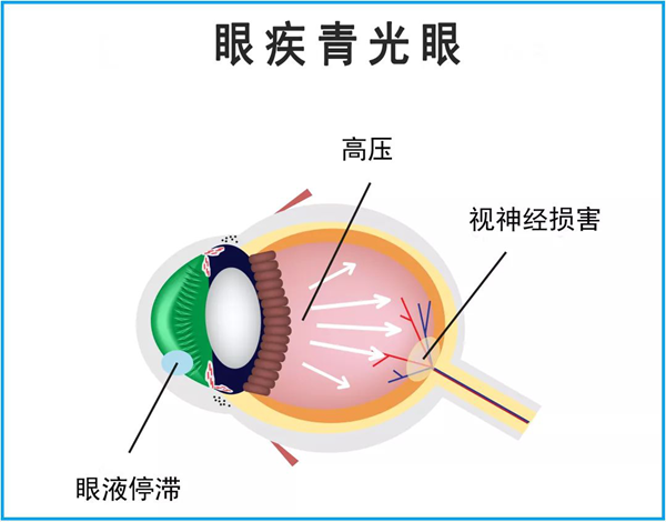 高度近視,屈光,青光眼,惠州希瑪眼科