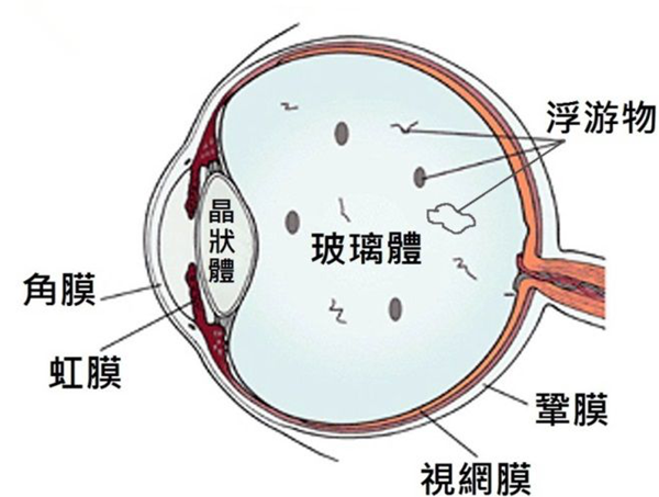 飛蚊癥,惠州治療飛蚊癥,惠州希瑪眼科醫院