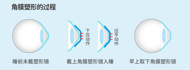 昆明配ok鏡的醫院有哪些？